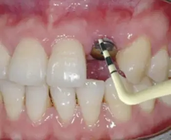 1 gab. Zondes Dziļums Pasākums Explorer Periodental NoHarm ar Implantiem Elastīgu Sveķu Materiāls Probs Zobu