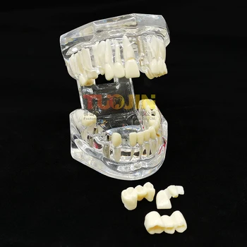 Zobu Implantācija Slimību Atjaunošana, Zobu Modeli, Medicīnas Zinātne Slimības Mācību Studiju skolu zobārstniecības iekārtas zobārsts rīks