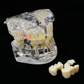 Zobu Implantācija Slimību Atjaunošana, Zobu Modeli, Medicīnas Zinātne Slimības Mācību Studiju skolu zobārstniecības iekārtas zobārsts rīks