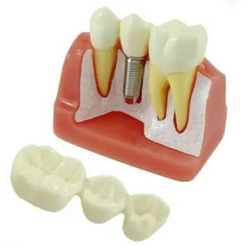 Zobu Mācību Studiju Modelis Iekavās Vadi Endo Implantu Vainagu Maryland Tilta Failus Zobu Analīze Ortodontijas Vaiga Typodont